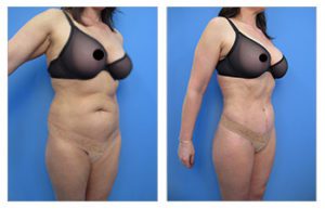 What is VASER High Definition Liposuction