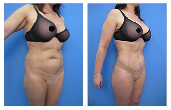 What is VASER High Definition Liposuction