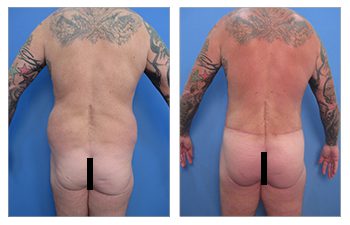 Tummy tuck and BBL surgery before and after.