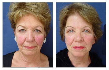 GMommy Upper Eyelid Blepharoplasty