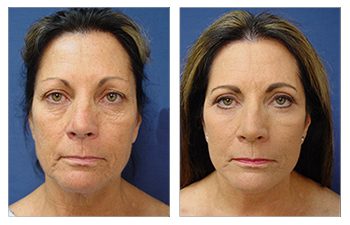 GMommy Facelift