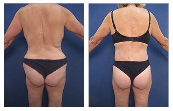 GMommy Lateral Thigh Tuck