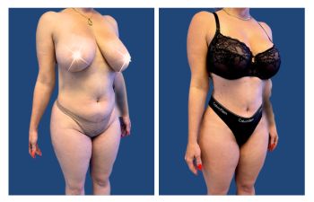 Do I Need a Garment After Tummy Tuck Surgery