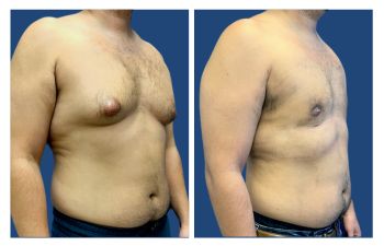 is-gynecomastia-painful?