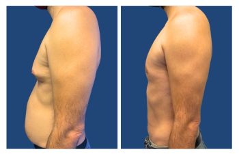 High definition liposuction gynecomastia